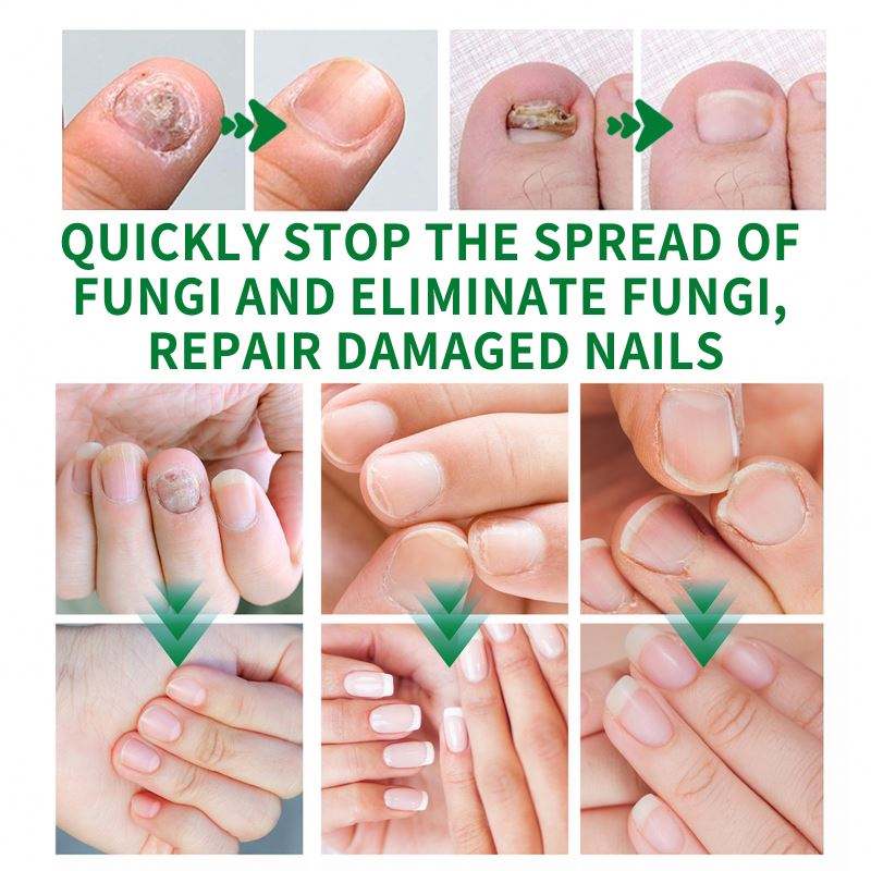 Jaysuing 7DAYS Ginger Anti Fungal Infection Foot Toe Nail with Fungus Treatments Oil Essence