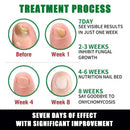 Jaysuing 7DAYS Ginger Anti Fungal Infection Foot Toe Nail with Fungus Treatments Oil Essence