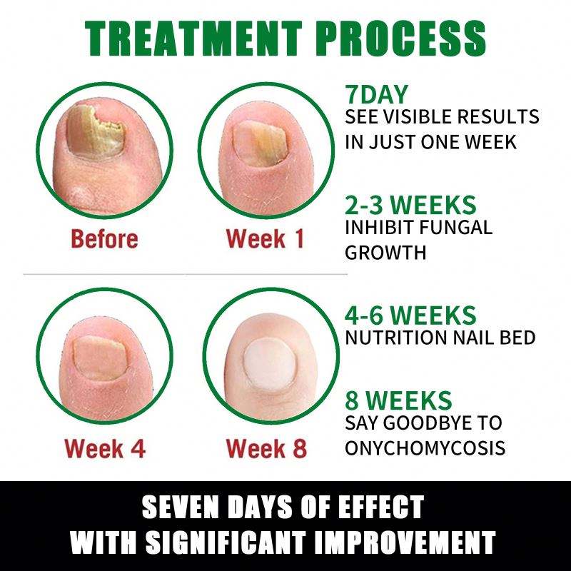 Jaysuing 7DAYS Ginger Anti Fungal Infection Foot Toe Nail with Fungus Treatments Oil Essence